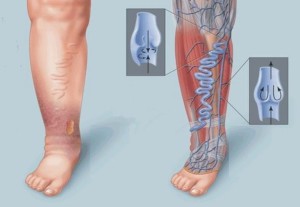 Тромбофлебит нижних конечностей требует внимания и профессионального подхода