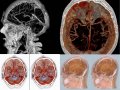 МРТ сосудов мозга — открывает тайны главного компьютера человека